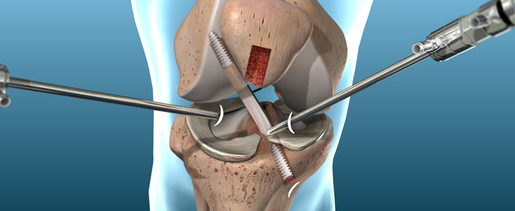 ACL Treatment