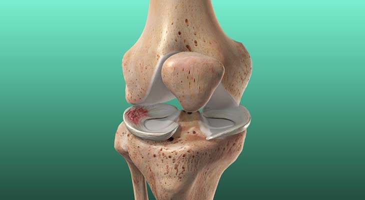 Meniscus Injuries